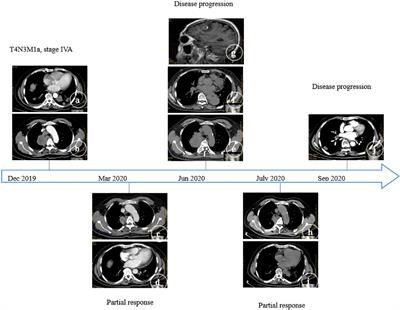 Transformation of adenocarcinoma to squamous cell carcinoma as a source of EGFR-TKI resistance: A case report and literature review